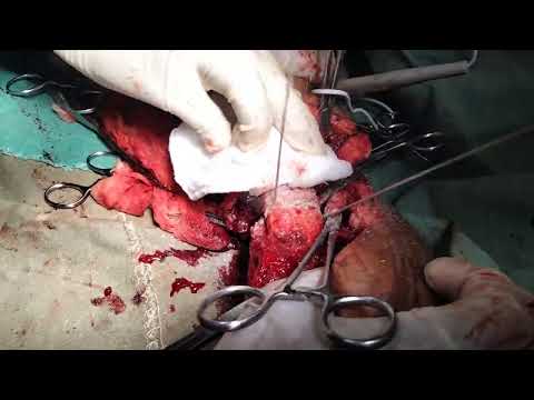 Gigli saw (femoral bone cuting)